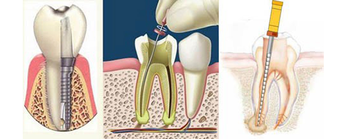 ENDODONZIA