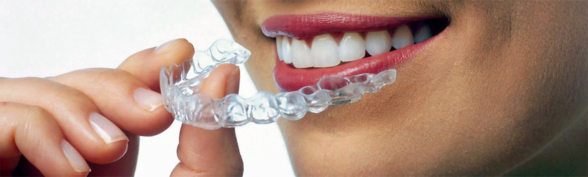 ORTODONZIA INVISIBILE